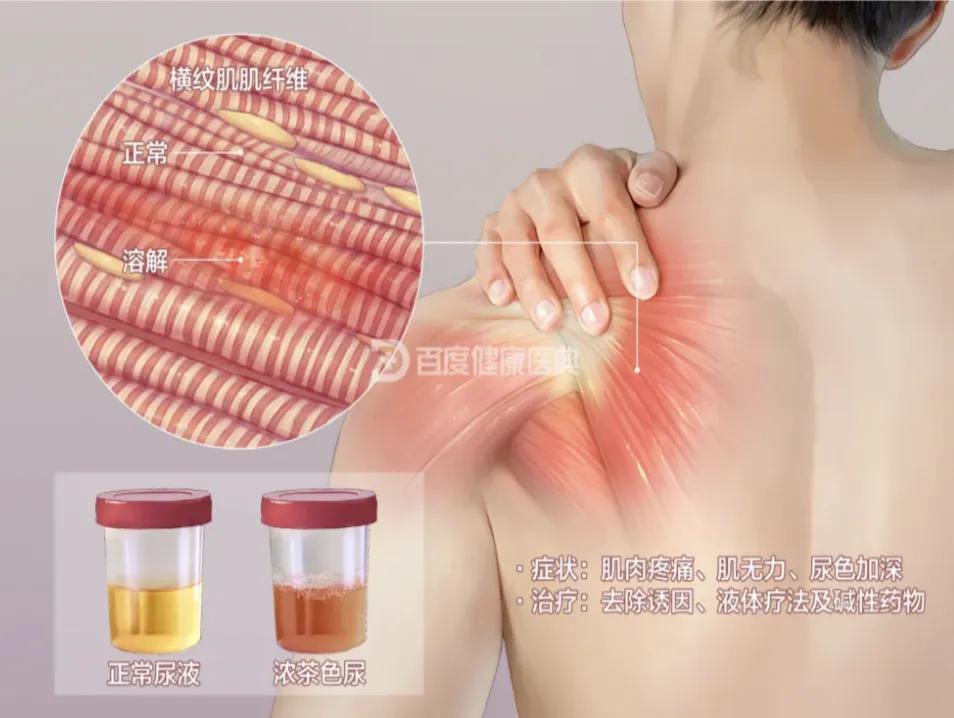 MK体育登录入口-警惕!小心这些药正在“溶解”你的肌肉